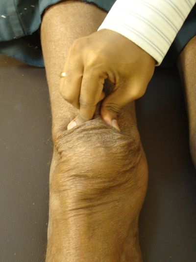 A person pinching the skin on the back of another person's knee.