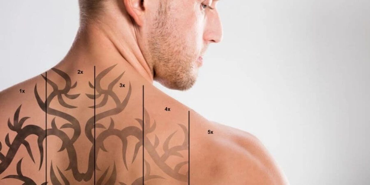 How Can You Remove A Tattoo