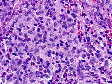 At higher power neoplastic cells with eosinophilic (pink) cytoplasm and irregular nuclei with freque