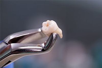 Extracted tooth held by tooth forceps