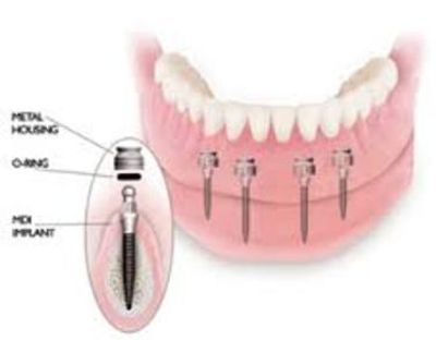 4 titanium mini all on 4 same day denture implants Armani Dentures