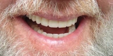 One Day Porcelain Denture Doctor of Armani Dentures Chevy Chase Washington DC