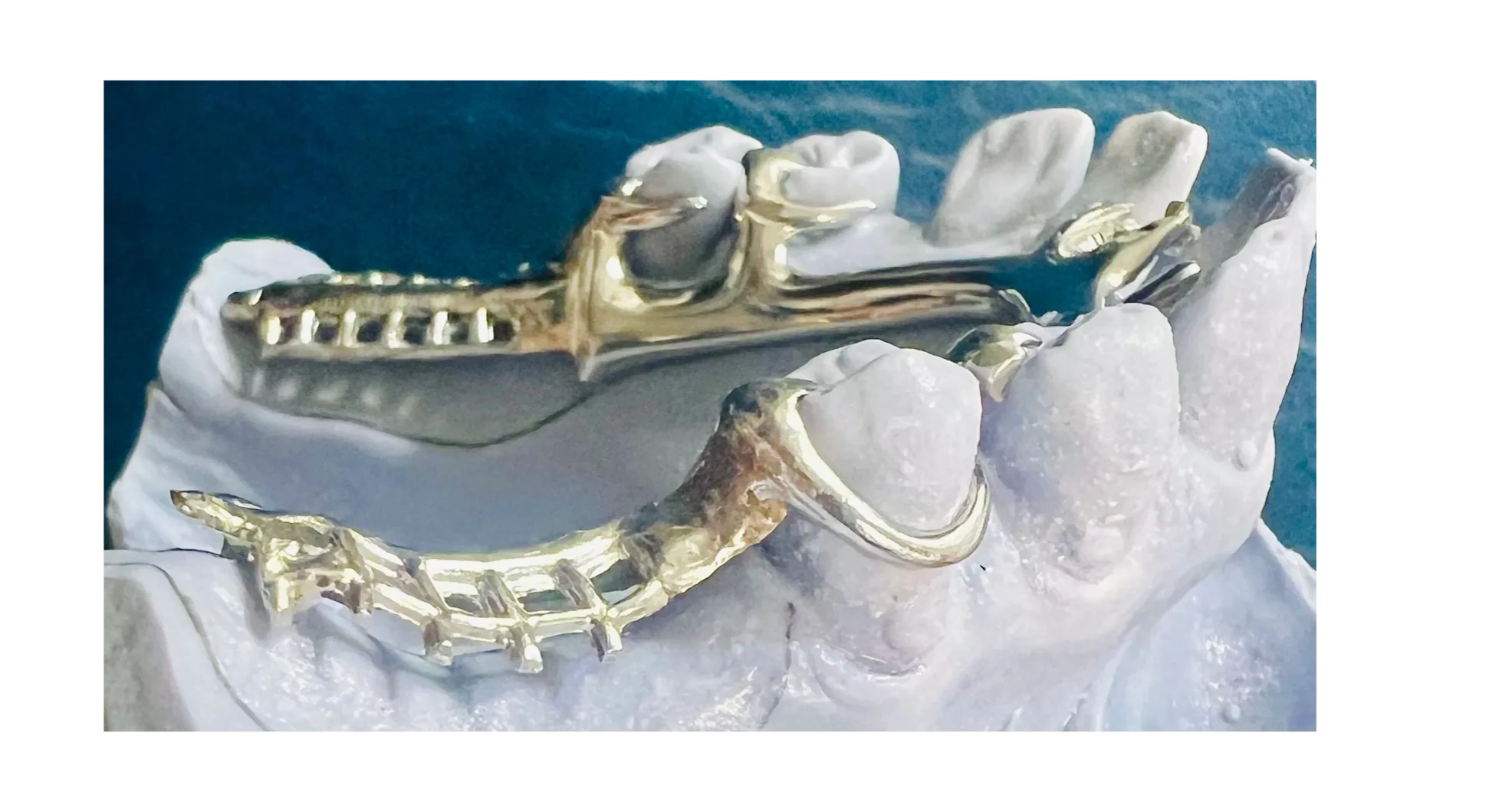 Cast Metal Frame Partial Denture shown on a model at Armani Dentures in Chevy Chase, MD