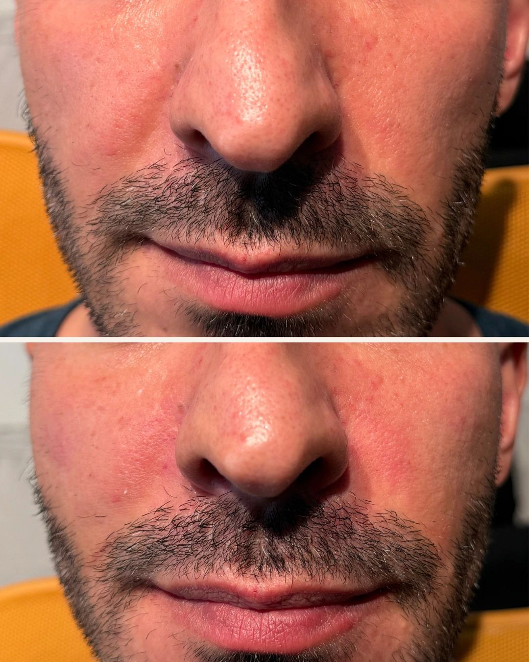 Before-and-after results following a personalized Radiesse biostimulator treatment at Ever Vita Aesthetic in Wayne, NJ.