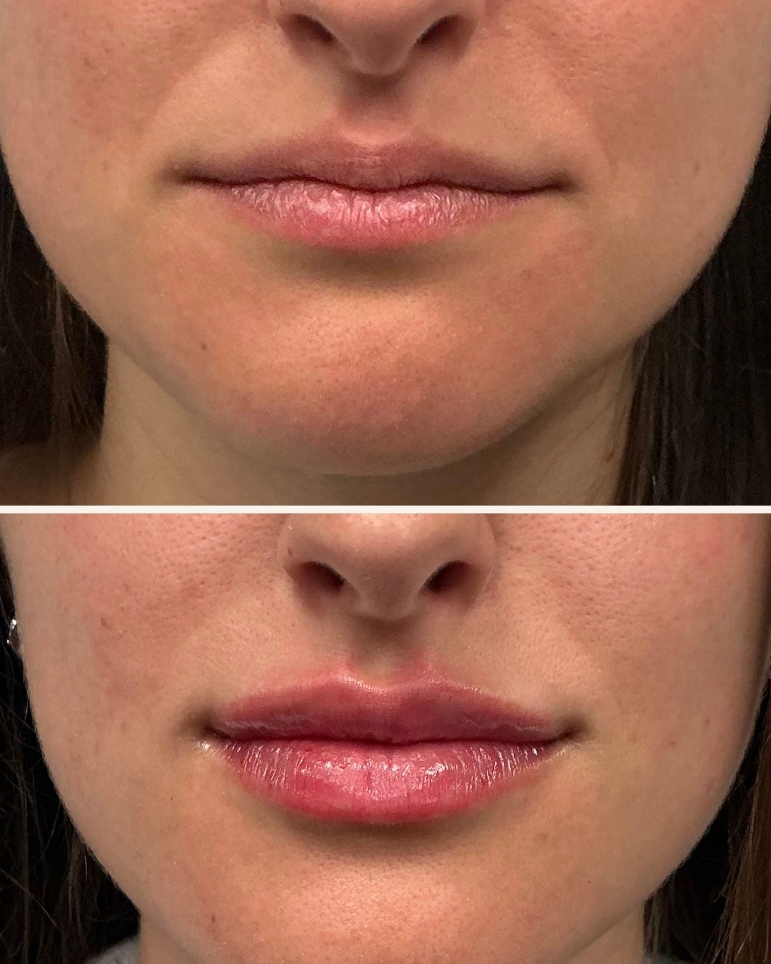 Before and after lip enhancement showing fuller lips.