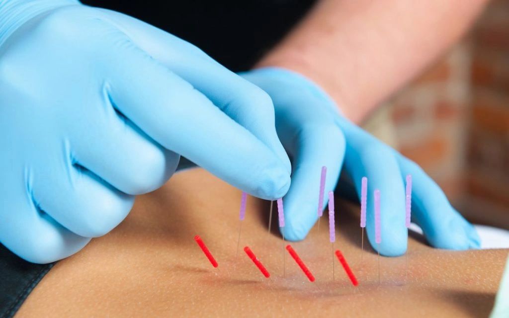 Intramuscular Stimulation / Dry Needling