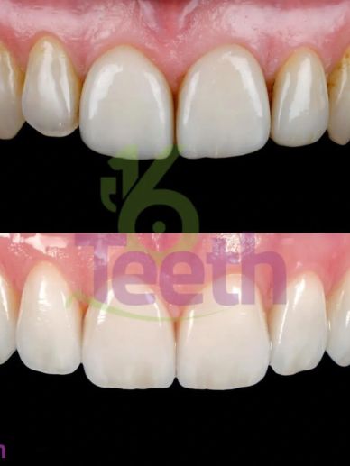 Before and after dental restoration showing improved teeth aesthetics.