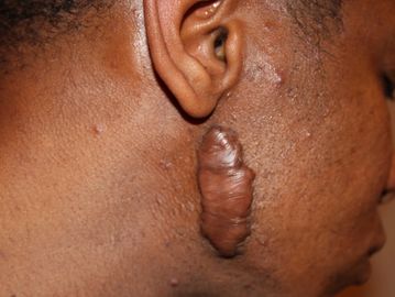 keloid treatment