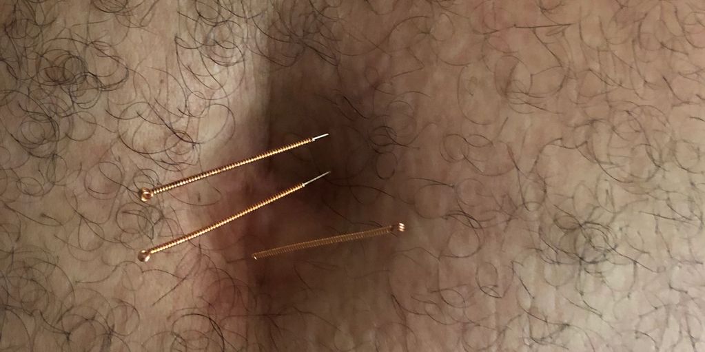 Tummy acupuncture for heavy and stiff leg .