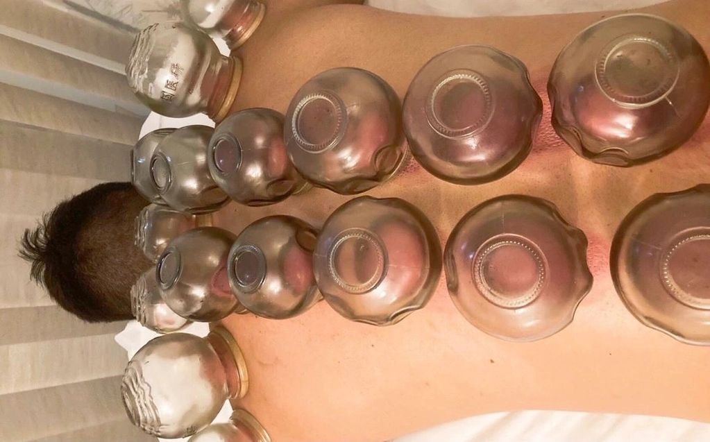 Cupping for scoliosis