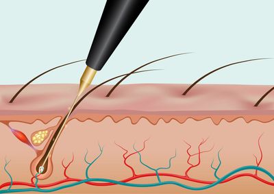 Electrolysis, hair removal, filament, skin cross section, hair follicles