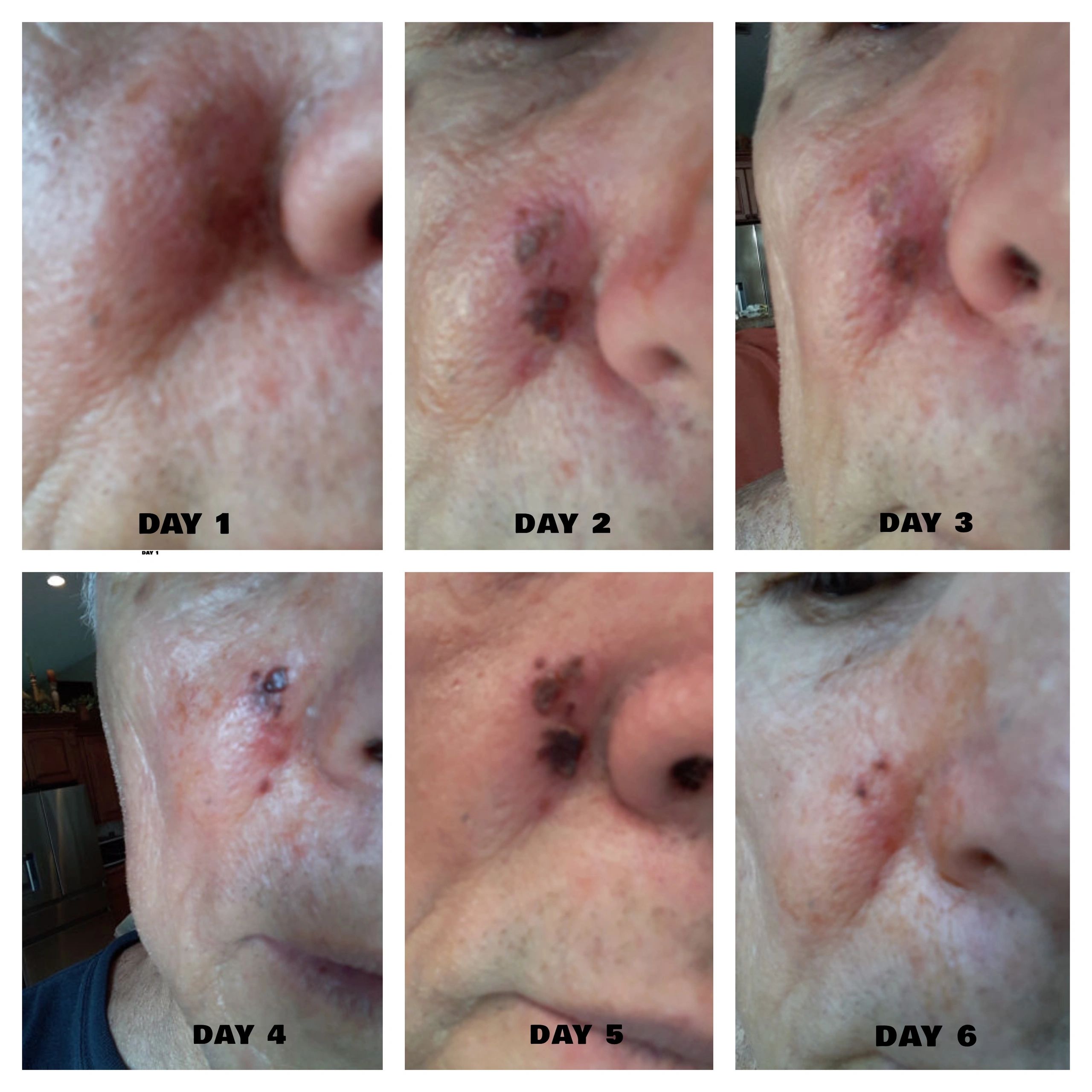 Brian's chemical face burn healing collage