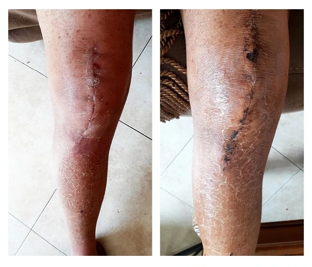 Brian's knee healing after replacement surgery