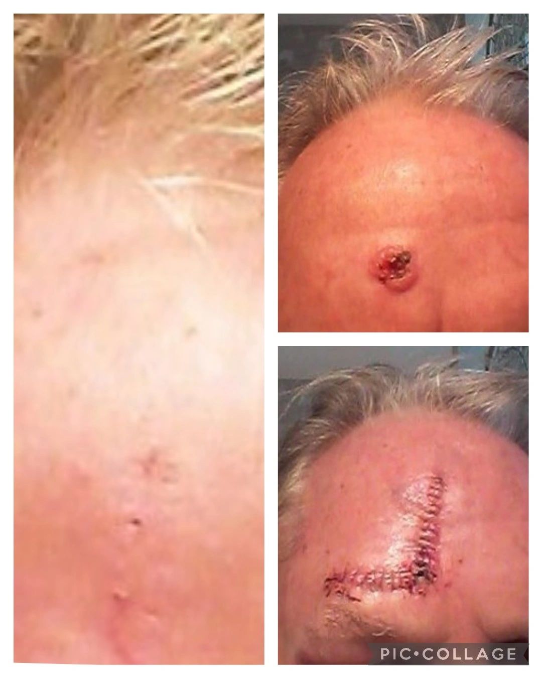 Anthony's before and after Mohs surgery healing