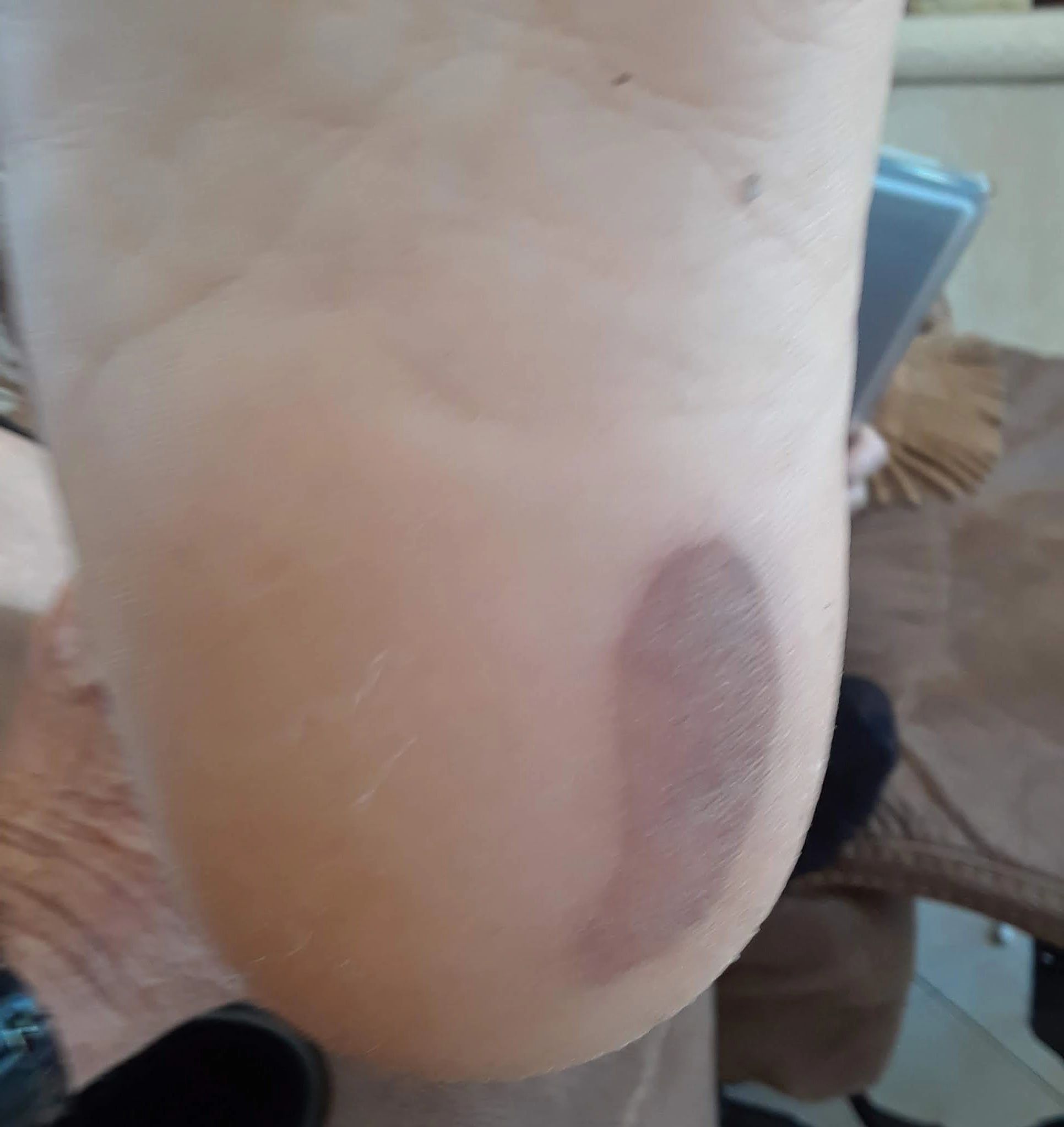 Lori's beach burn healing
