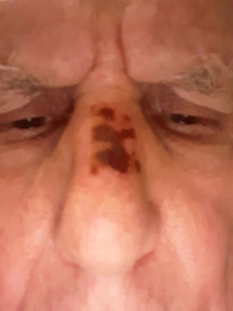 Shawn's nose sunburn healing