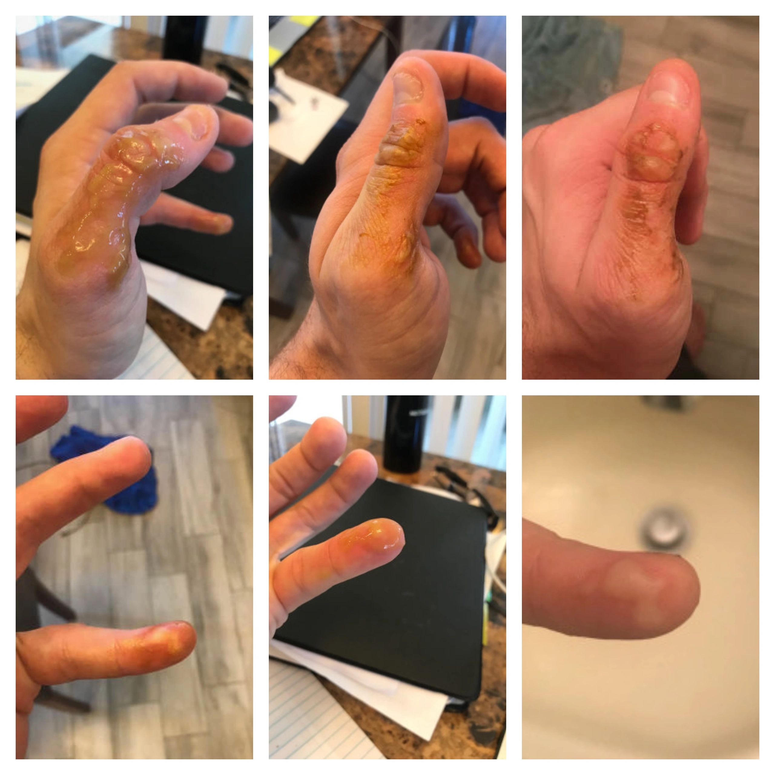 Shawn's burn healing progress