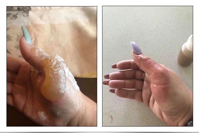 Melanie's update about her burn improving