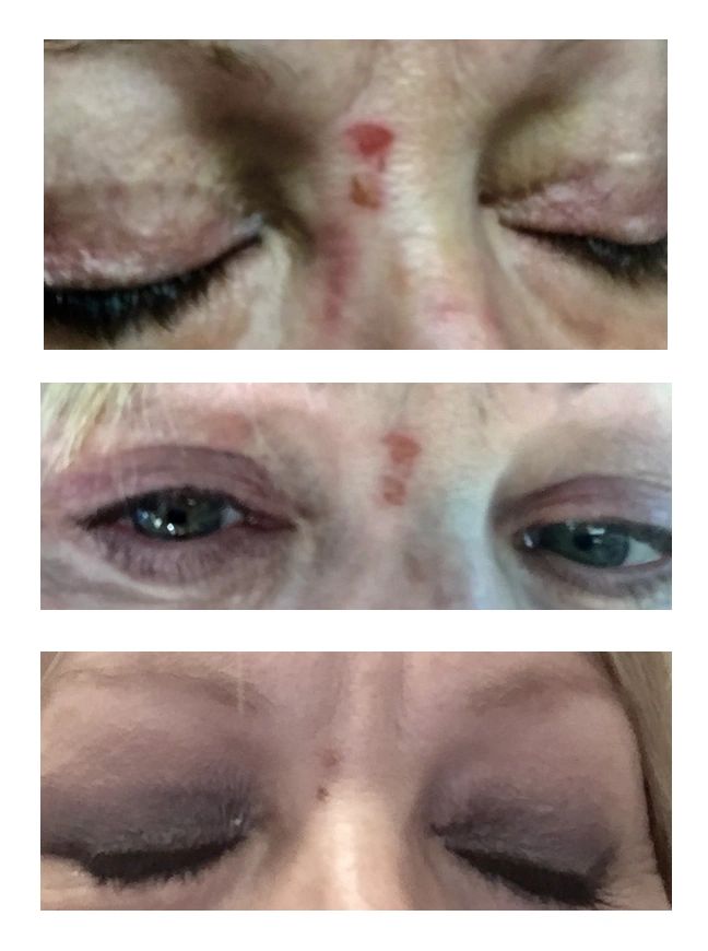 Jyll's face injury day 1