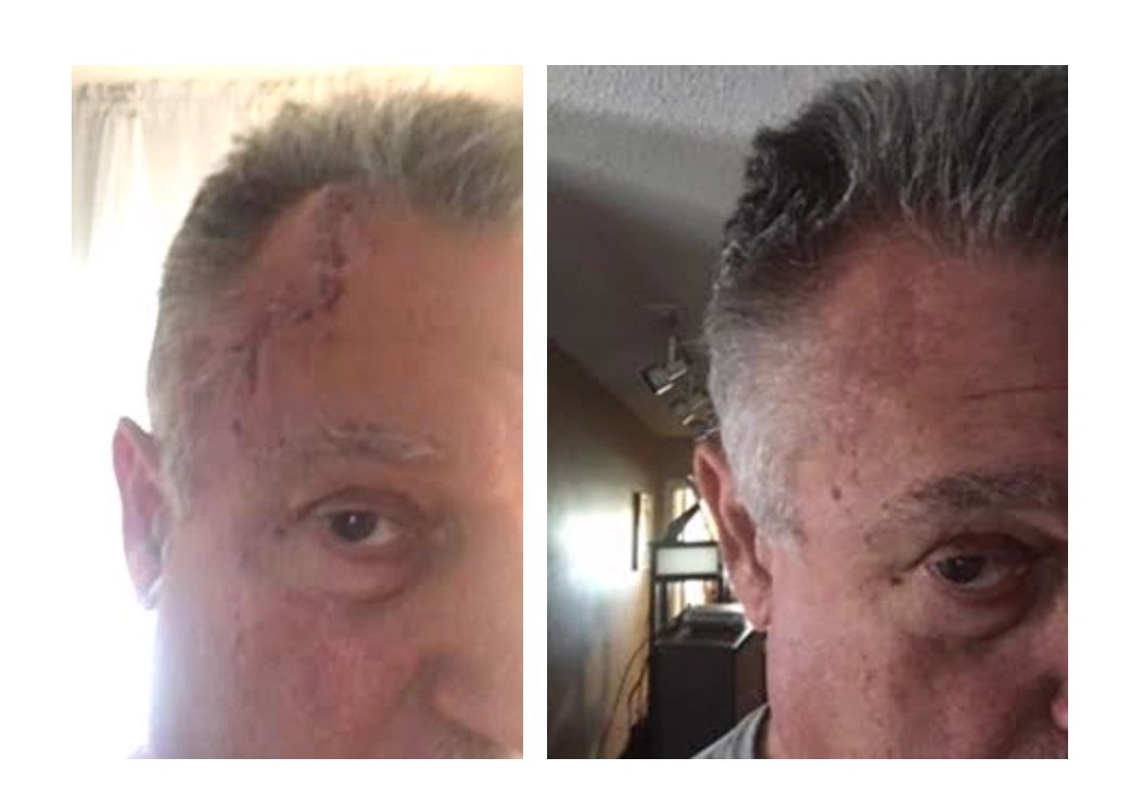 Steve's Mohs surgery scar healing