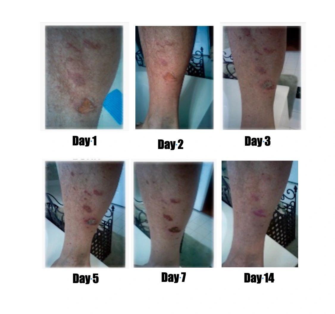 Brian's leg burn healing progress