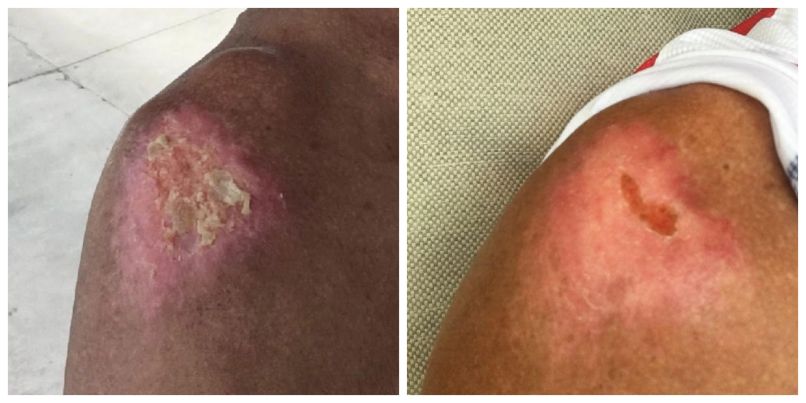 Trish's bike accident injuries healing