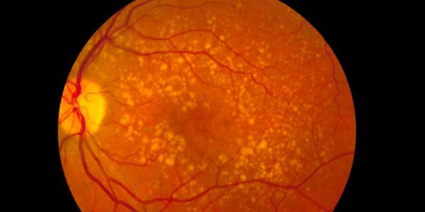Professor Ian Pearce
Ophthalmologist Liverpool
Cataract
AMD
Macular Hole
Retinal Expert