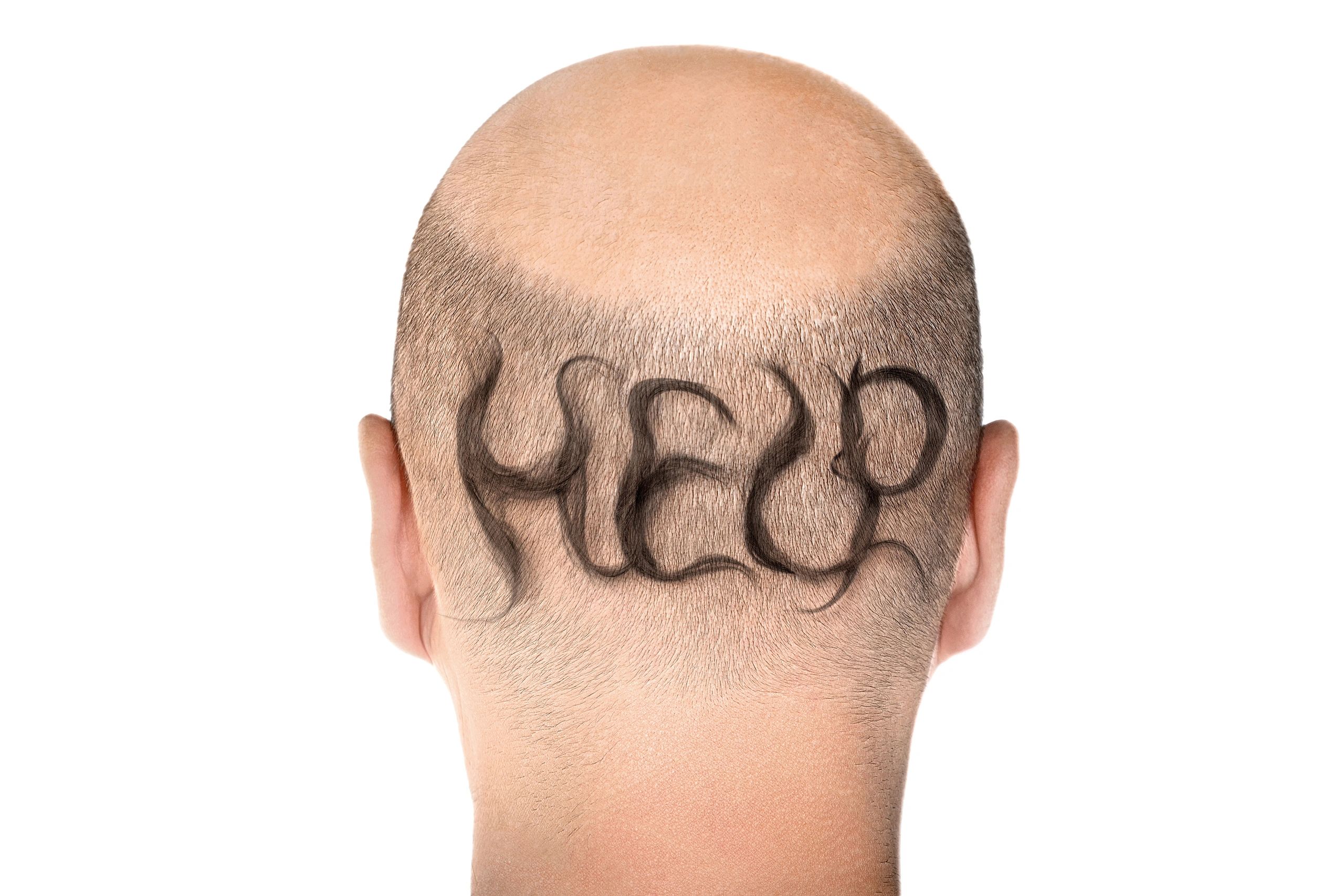 Need help with hair loss? Our experts will guide you to your hair restoration goals