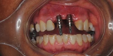Implantes dentales en la mandíbula superior.