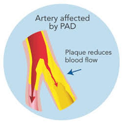 artery affected by Peripheral Vascular Disease (PVD) with reduced blood flow from plaque 