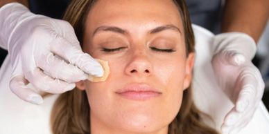 Chemical Peels Columbus GA