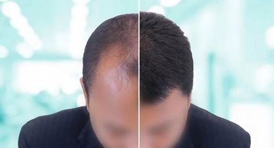 What is Hair Transplantation?
