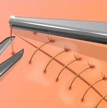 Close-up of surgical sutures being carefully stitched into skin with precision tools.