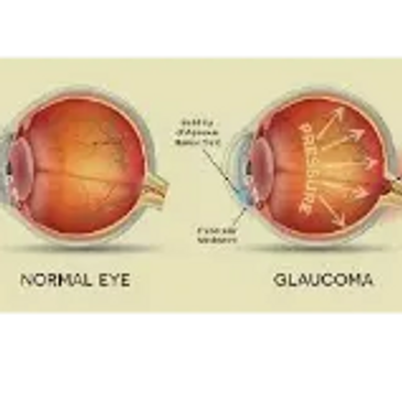 Diagram comparing a normal eye and an eye with glaucoma.