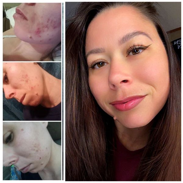 Before and after images showing acne improvement on a woman's face.