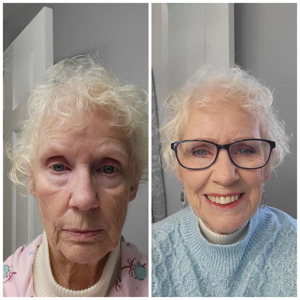 Before and after transformation of an elderly woman showing a cheerful smile and glasses.