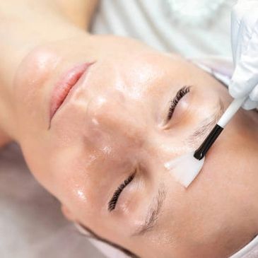 chemical peel