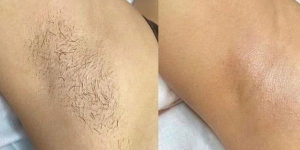 Woman showcasing smooth underarm with pain-free laser hair removal. the loft spa barrington 