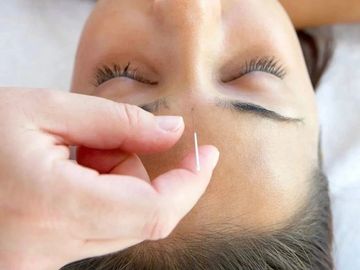 acupuncture treatment