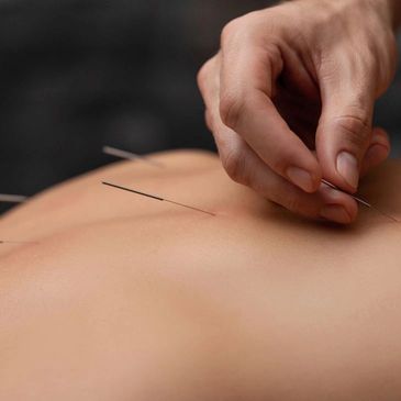 acupuncture needles being place on a person's back