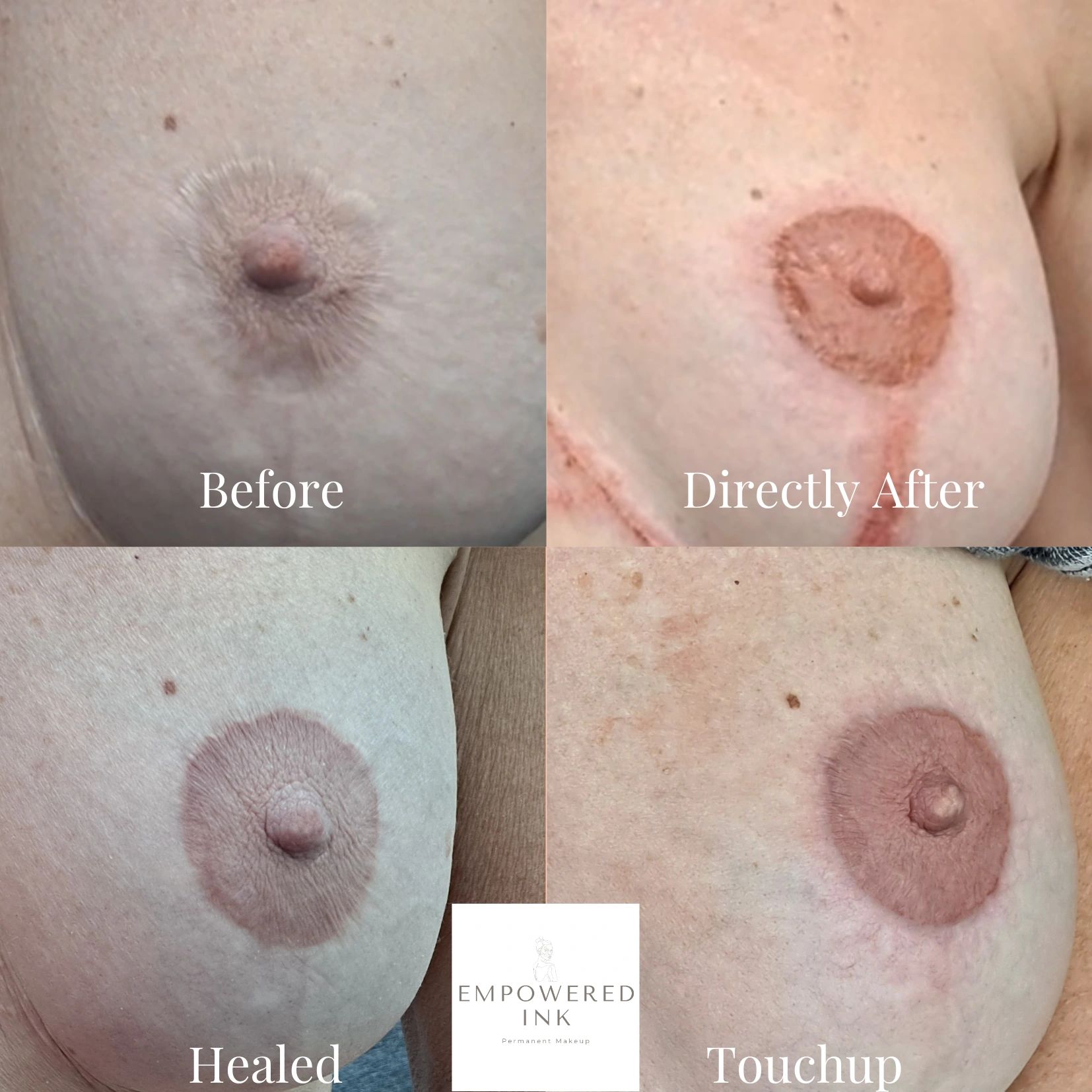 Tattoos to Hide Breast Reduction Scars