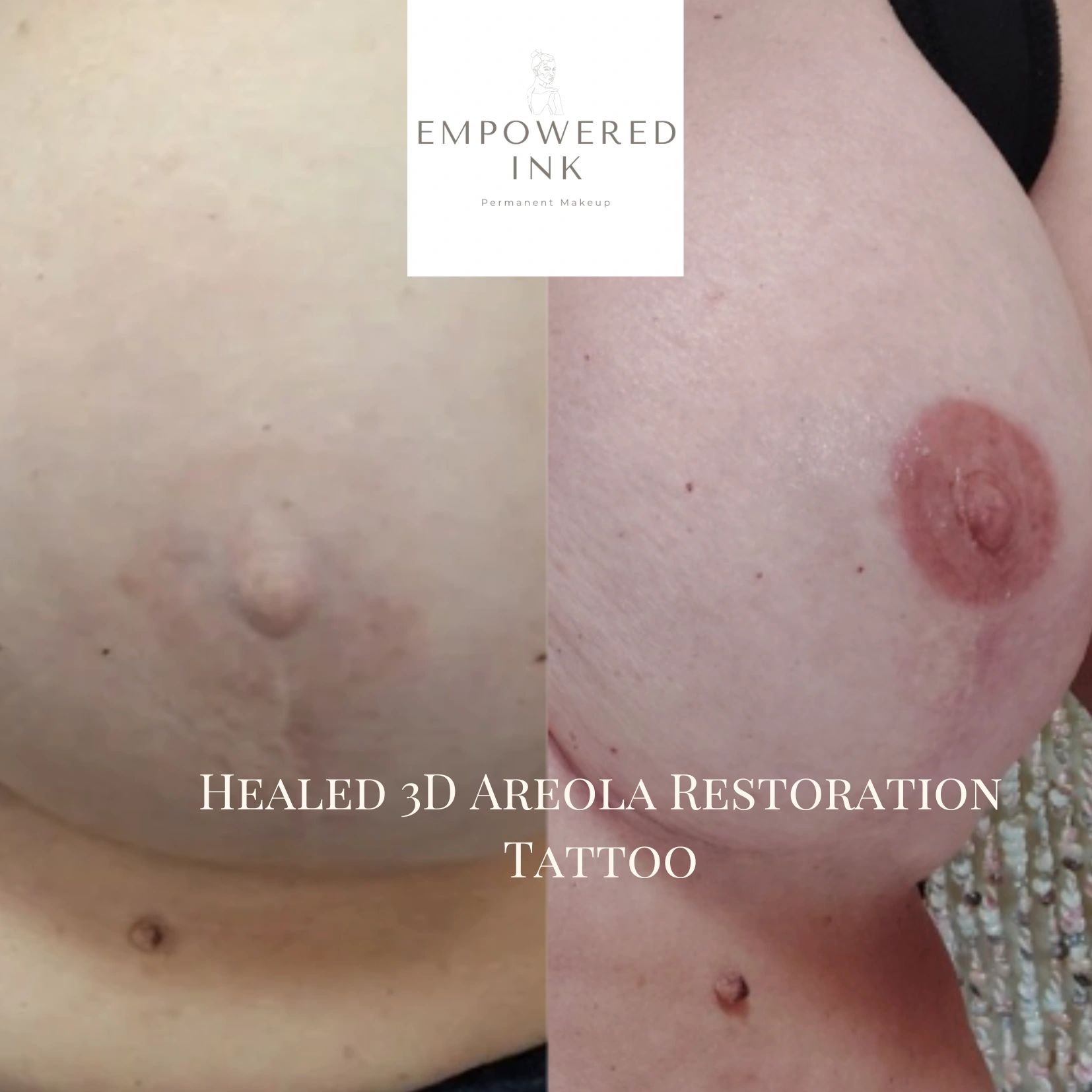 Healing Scars with Tattoos After Breast Reduction