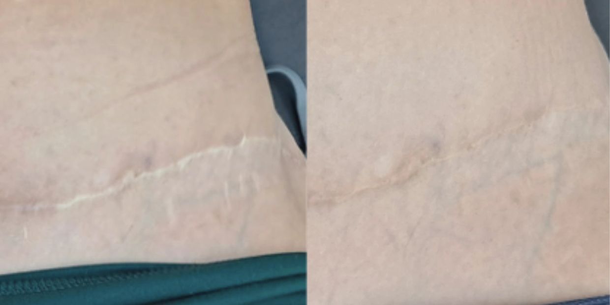 Tummy Tuck Scar Camouflage Tattoo