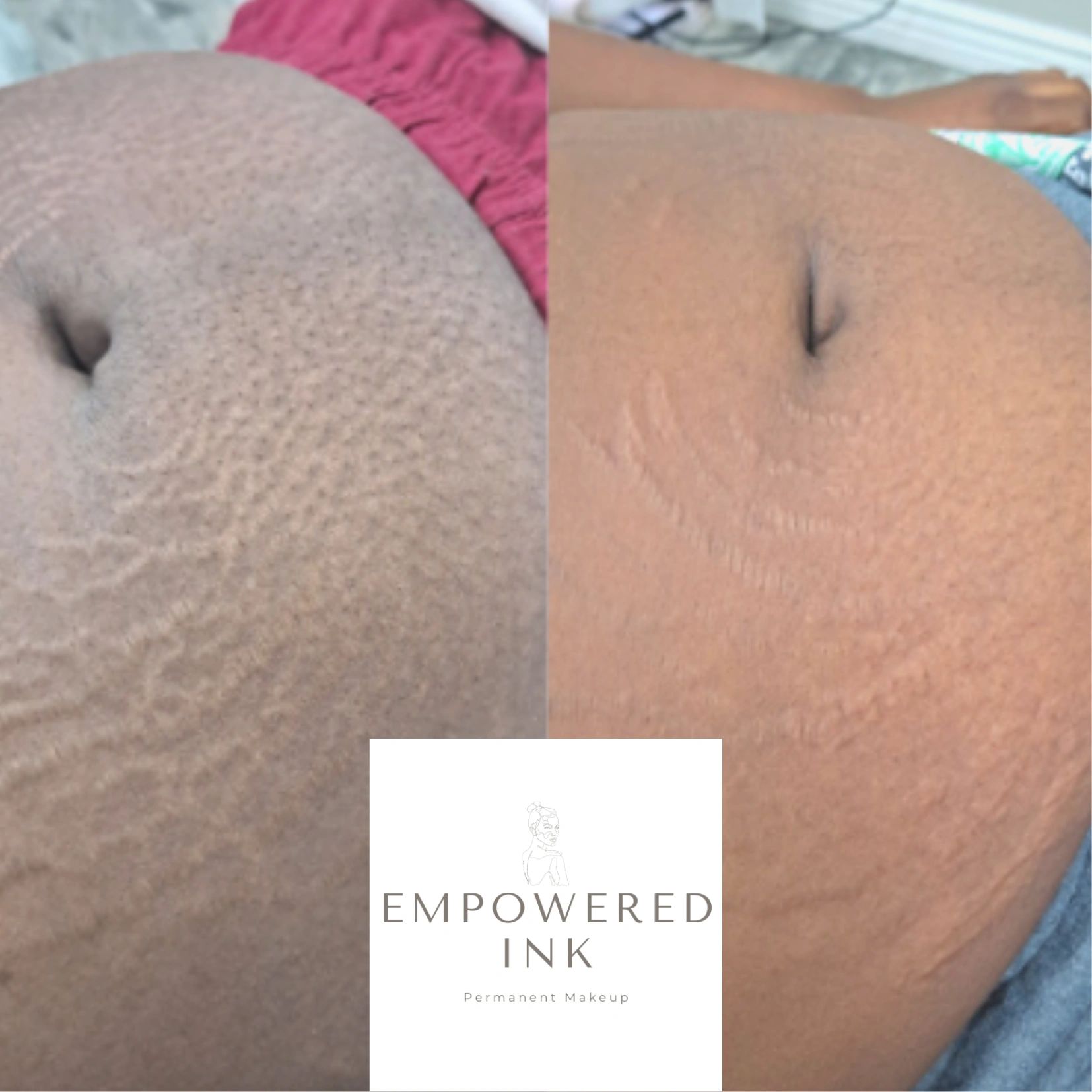Unveil the New You with Stretch Mark Camouflage in Fort Worth