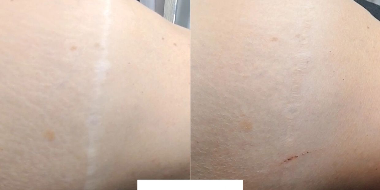 Scar Camouflage Treatments scottsdale arizona 
