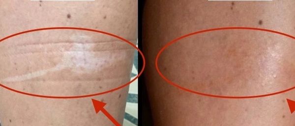 Before and after photos of a skin correction tattoo on an upper leg.