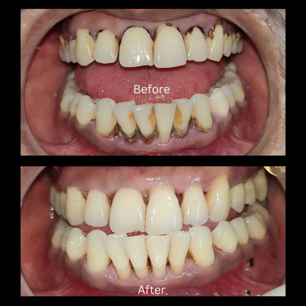 Before and after images showing significant dental cleaning and stain removal.