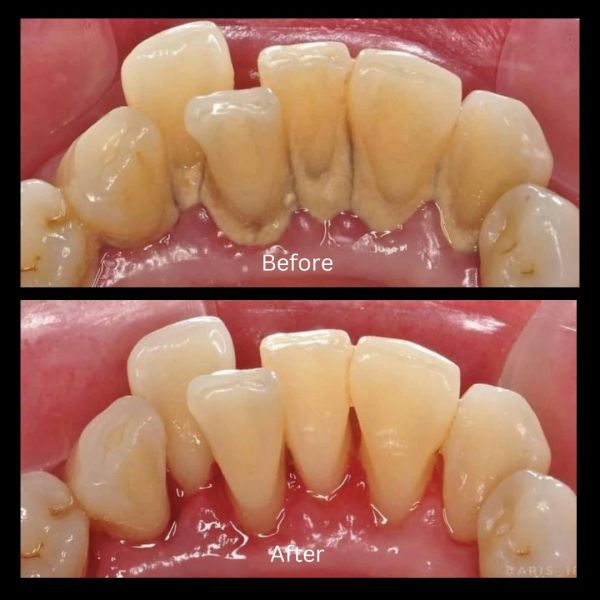 Close-up of teeth before and after professional cleaning, showing plaque removal.