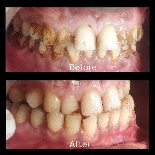 Before and after teeth cleaning showing significant stain removal.