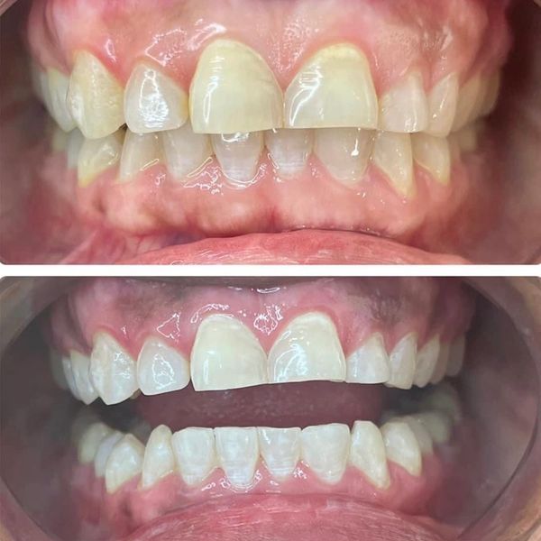 Teeth Whitening Before and After